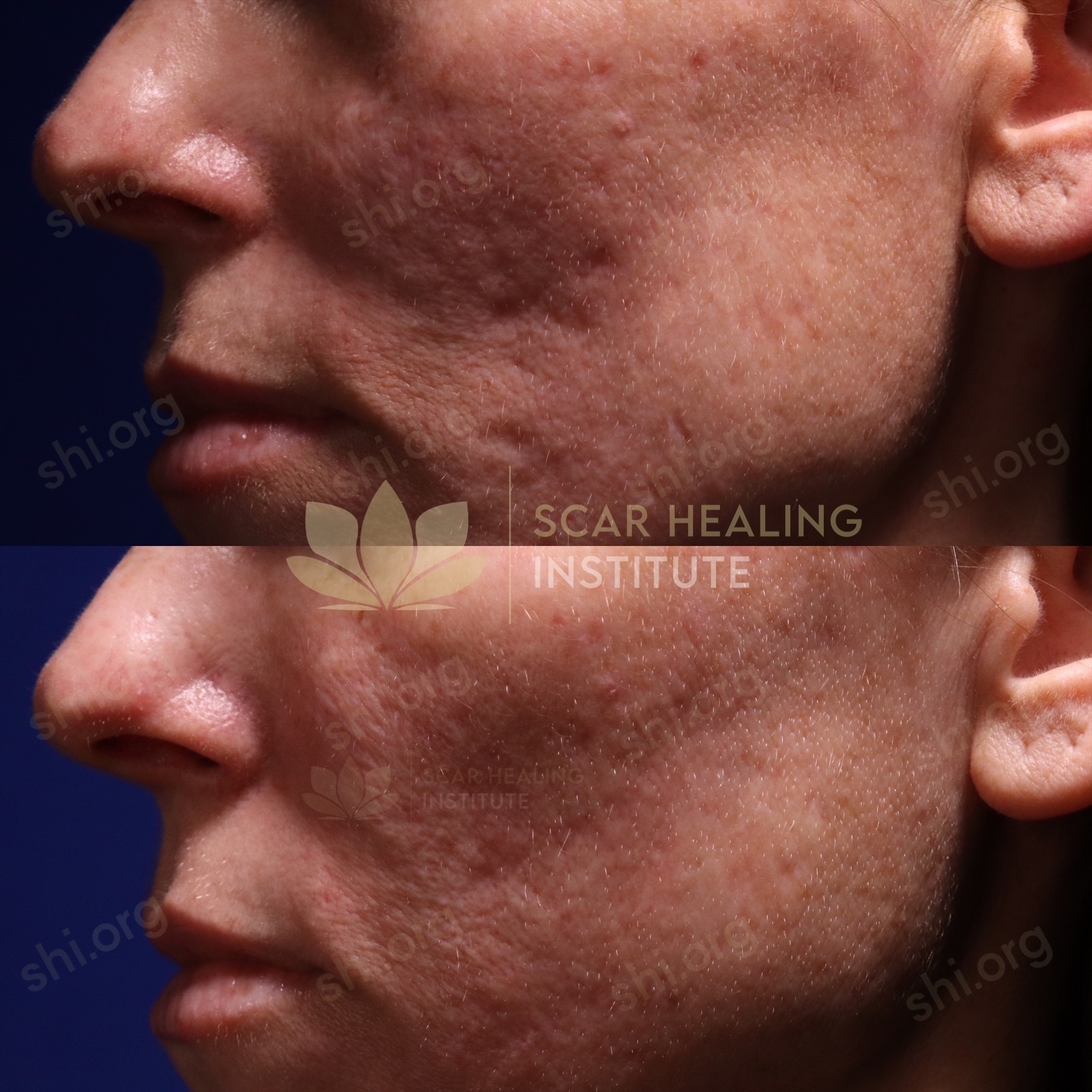 LM SHI 31 - Acne Scarring Active Acne Patient Results Scar Healing