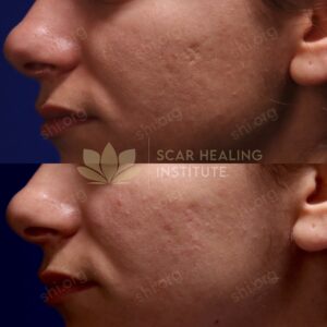 LZ SHI 30 - Acne Scarring Active Acne Patient Results Scar Healing