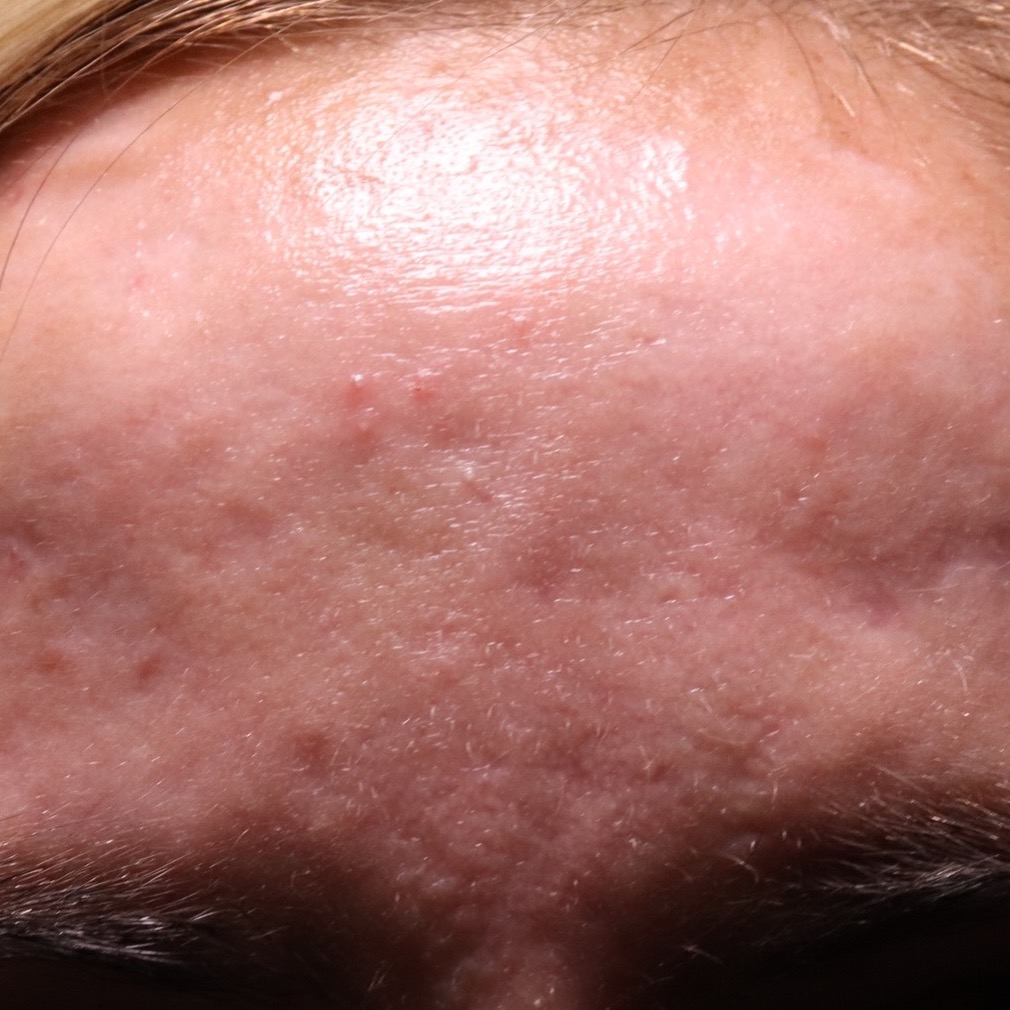 SHI Patient 33 After Active Acne Treatments at Scar Healing Institute