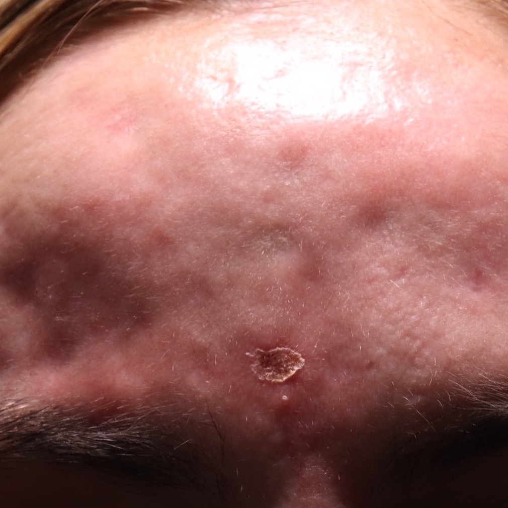 SHI Patient 33 Before Active Acne Treatments at Scar Healing Institute