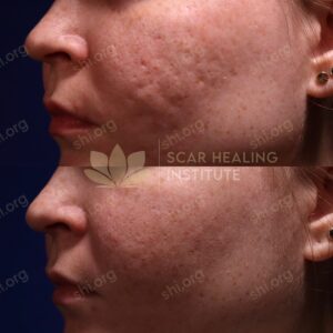 MS SHI 58 - Acne Scarring Active Acne Patient Results Scar Healing
