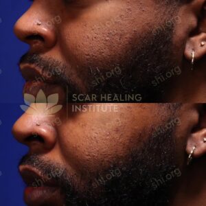 RJT SHI 54 - Acne Scarring Active Acne Patient Results Scar Healing