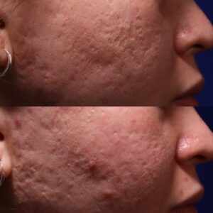 AP SHI 68 - Acne Scarring Active Acne Patient Results Scar Healing