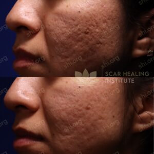 HD SHI 64 - Acne Scarring Active Acne Patient Results Scar Healing