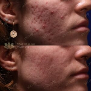 SB SHI 65 - Acne Scarring Active Acne Patient Results Scar Healing