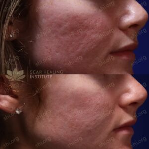 VB SHI 69 - Acne Scarring Active Acne Patient Results Scar Healing