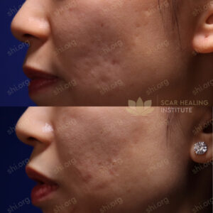 CP SHI 71 - Acne Scarring Active Acne Patient Results Scar Healing