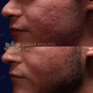 SH SHI 60 - Acne Scarring Active Acne Patient Results Scar Healing