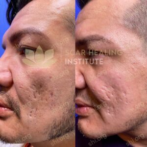 UK SHI 48 - Acne Scarring Active Acne Patient Results Scar Healing