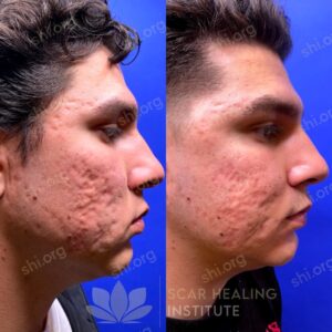 JH SHI 18 - Acne Scarring Active Acne Patient Results Scar Healing