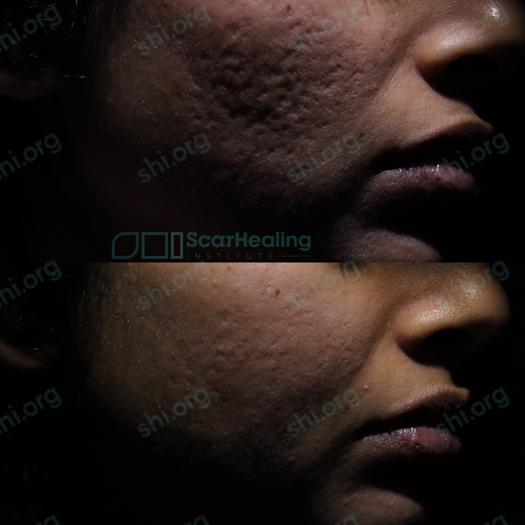 RR SHI 78 - Acne Scarring Active Acne Patient Results Scar Healing