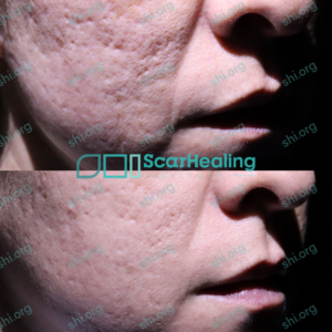 ABD SHI 102 - Acne Scarring Active Acne Patient Results Scar Healing