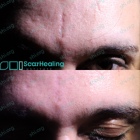 AM_SHI_91_B AM SHI 91 - Traumatic Scarring Patient Results Scar Healing