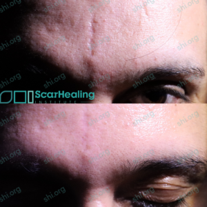 AM SHI 91 - Traumatic Scarring Patient Results Scar Healing