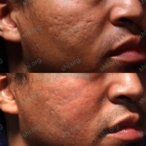 AP2 SHI 88 - Acne Scarring Active Acne Patient Results Scar Healing