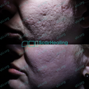 BS SHI 96 - Acne Scarring Active Acne Patient Results Scar Healing