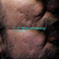 DB_SHI_100 DB SHI 100 - Acne Scarring Active Acne Patient Results Scar Healing
