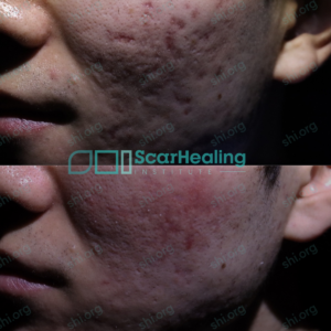 DC SHI 95 - Acne Scarring Active Acne Patient Results Scar Healing