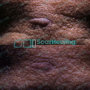 DL SHI 98 - Hypertrophic Scarring Patient Results Scar Healing