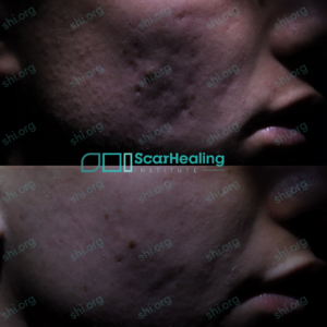 JK2 SHI 94 - Acne Scarring Active Acne Patient Results Scar Healing