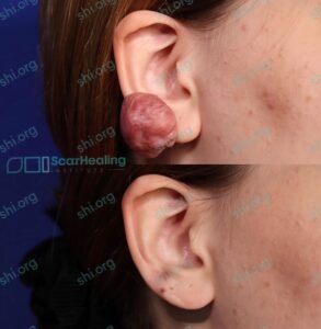 MF SHI 103 - Keloid Scar Patient Results Scar Healing