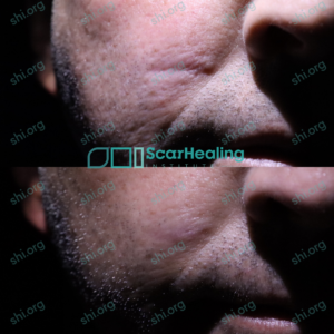 MJ SHI 89 - Surgical Scarring Patient Results Scar Healing