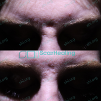 NC_SHI_92 NC SHI 92 - Atrophic Scarring Patient Results Scar Healing