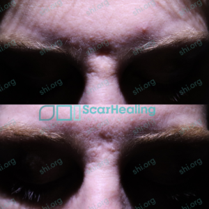 NC SHI 92 - Atrophic Scarring Patient Results Scar Healing