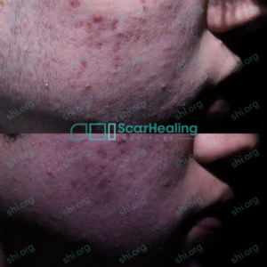 RD SHI 101 - Acne Scarring Active Acne Patient Results Scar Healing