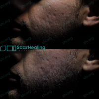 SM_SHI_90 SM SHI 90 - Acne Scarring Patient Results Scar Healing