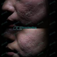 SS_SHI_97 SS SHI 97 - Acne Scarring Active Acne Patient Results Scar Healing