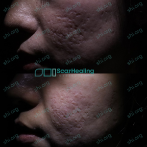 SS SHI 97 - Acne Scarring Active Acne Patient Results Scar Healing