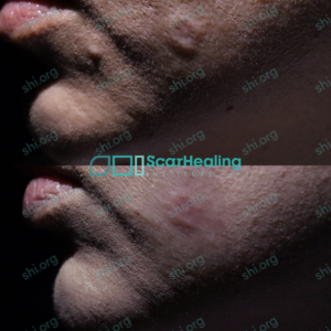 TS SHI 99 - Hypertrophic Scarring Patient Results Scar Healing