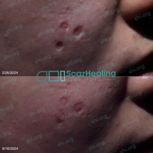 YL SHI 93 - Atrophic Scarring Patient Results Scar Healing