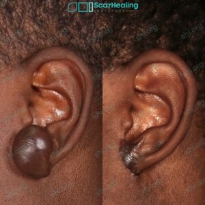 SHI 104 Keloid Scar Patient Results Scar Healing