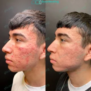 AL SHI 1 - Non Acne Scarring Active Acne Patient Results