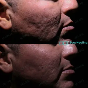 BG SHI 106 - Acne Scarring Active Acne Patient Results Scar Healing