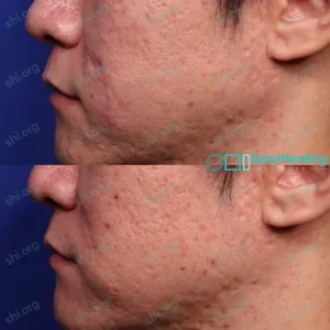 DK SHI 6 - Atrophic Scarring Patient Results Scar Healing