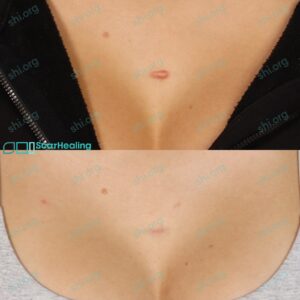 GS SHI 105 - Keloid Scar Patient Results Scar Healing