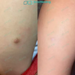 IA SHI 15 Hypertrophic Scarring Patient Results Scar Healing