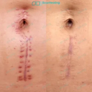 JA SHI 52 Hypertrophic Surgical Scarring Patient Results Scar Healing