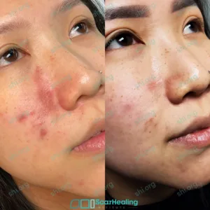 JC SHI 19 - Atrophic Scarring Patient Results Scar Healing