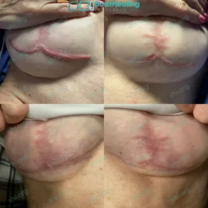 JL SHI 24 Hypertrophic Scarring Patient Results Scar Healing