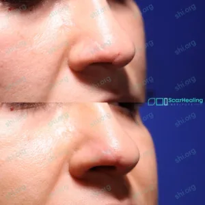 JM SHI 21 - Atrophic Scarring Patient Results Scar Healing