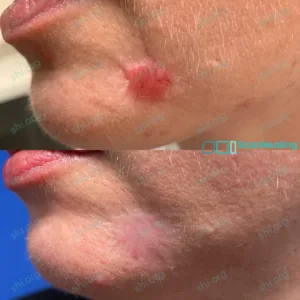 LS SHI 27 Non Acne Scarring Patient Results