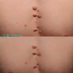 NY SHI 37 - Keloid Scar Patient Results Scar Healing