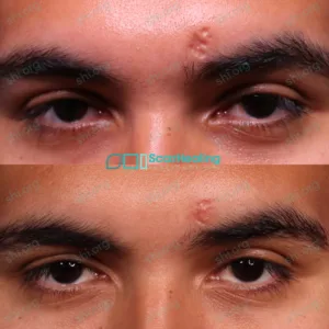 OC SHI 38 - Atrophic Scarring Patient Results Scar Healing