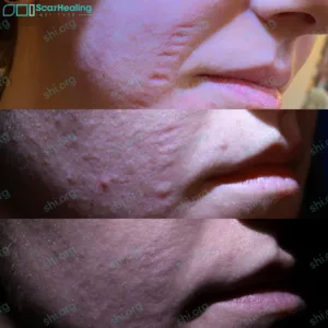 PM SHI 40 - Atrophic Scarring Patient Results Scar Healing