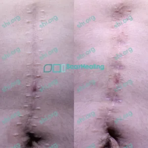 SHI Patient 82 AC Hypertrophic Surgical Scar Treatments