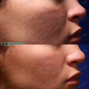 SH SHI 45 - Atrophic Scarring Patient Results Scar Healing